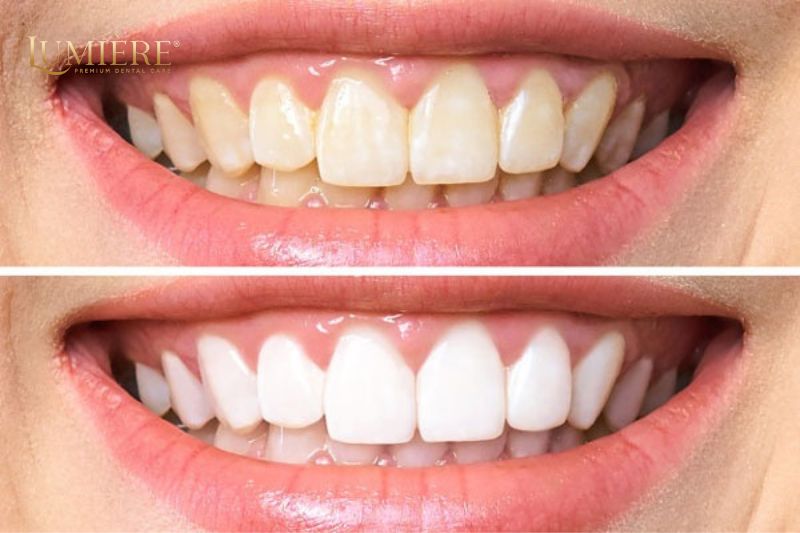 Mách bạn các phương pháp tẩy trắng răng an toàn và hiệu quả 1 Khi nào nên thực hiện tẩy trắng răng?