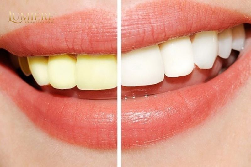 Mách bạn các phương pháp tẩy trắng răng an toàn và hiệu quả 2 Tẩy trắng răng an toàn tại phòng khám nha khoa