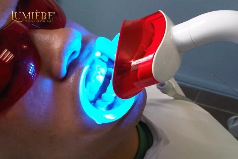 Đèn tẩy trắng răng có phải là phương pháp tốt để làm trắng răng hay không? 3 Sử dụng đèn tẩy trắng răng cho nha khoa có tốt hay không?