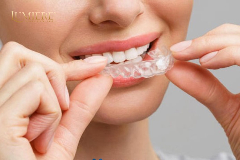 Máng tẩy trắng răng: Cách sử dụng, ưu nhược điểm và lưu ý 2 Cách sử dụng máng tẩy trắng răng