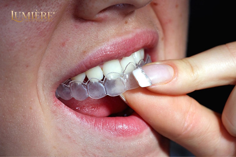 Máng tẩy trắng răng: Cách sử dụng, ưu nhược điểm và lưu ý 3 Ưu nhược điểm của máng tẩy trắng răng