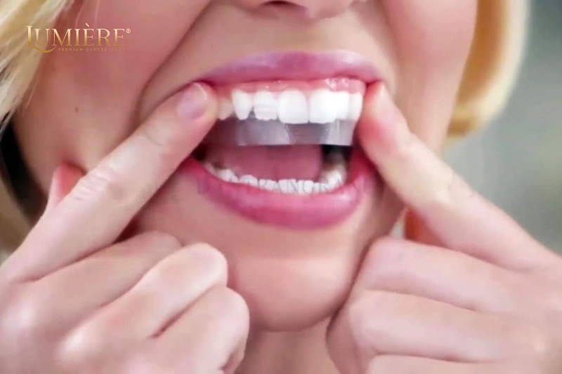 Hướng dẫn cách dùng và những lưu ý khi dùng miếng dán trắng răng 3 Những điều cần chú ý khi dùng miếng dán trắng răng