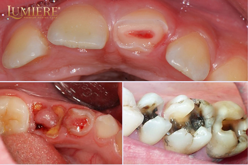 Cách nhổ răng sâu chỉ còn chân răng tại nhà an toàn hiệu quả 3 Các bước nhổ răng sâu chỉ còn chân tại nhà