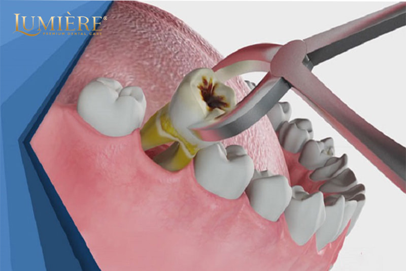 Nhổ răng cấm: quy trình, nguyên nhân và cách chăm sóc sau phẫu thuật 2 Nguyên nhân gây răng cấm và triệu chứng liên quan