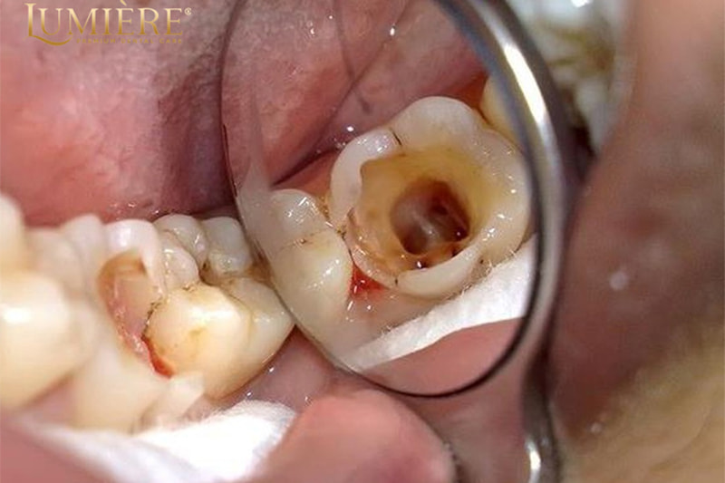 Nhổ răng cấm: quy trình, nguyên nhân và cách chăm sóc sau phẫu thuật 1 Nhổ răng cấm có đau không?