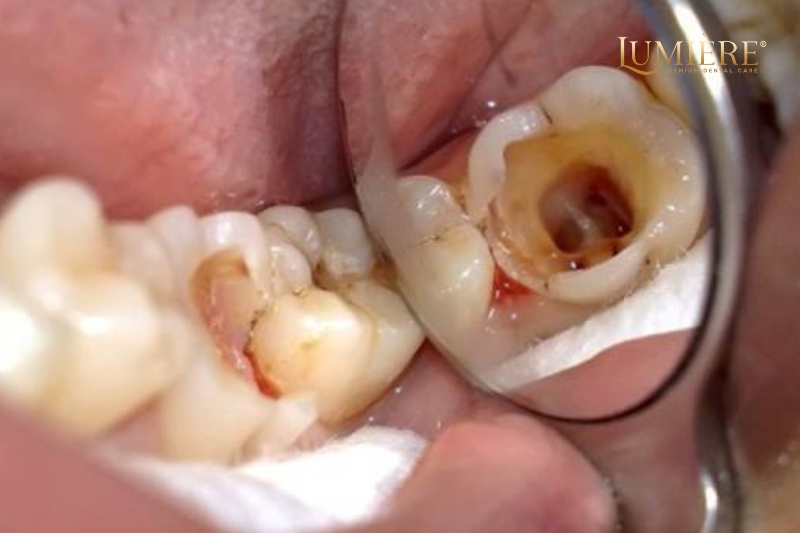 Cách nhổ răng hàm bị sâu tại nhà - Những hậu quả và cách phòng ngừa 1 Những nguyên nhân gây ra răng hàm bị sâu