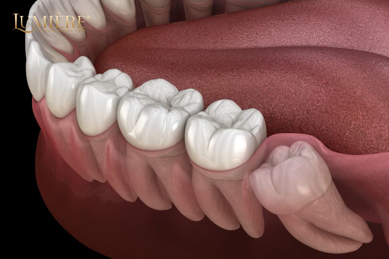 Có nên nhổ răng khôn hay không? Lợi ích khi nhổ răng khôn 2 Nhổ răng khôn sớm giúp giảm đau và giảm mức độ lo lắng cho bệnh nhân