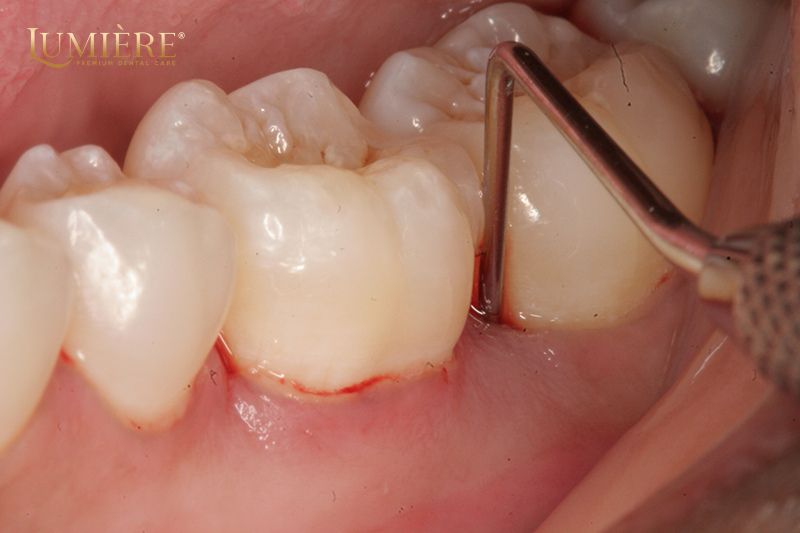 Có nên nhổ răng khôn hay không? Lợi ích khi nhổ răng khôn 1 Răng khôn có vai trò gì? Tại sao phải nhổ răng khôn?
