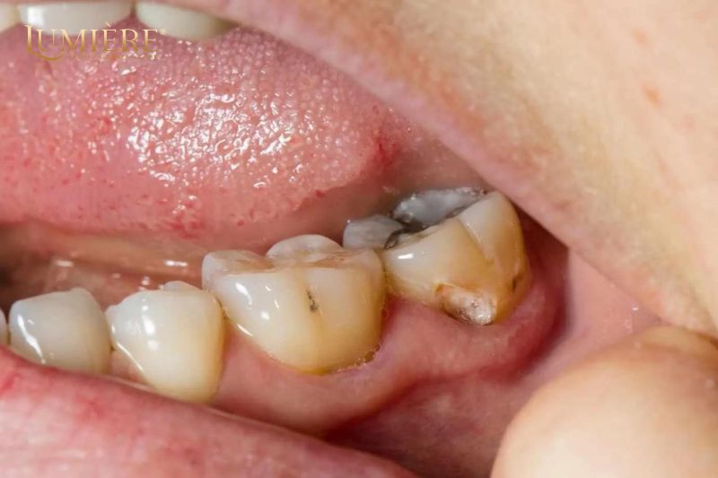 Có nên nhổ răng khôn hay không? Lợi ích khi nhổ răng khôn 3 Nhổ răng khôn là một chiến lược phòng ngừa quan trọng