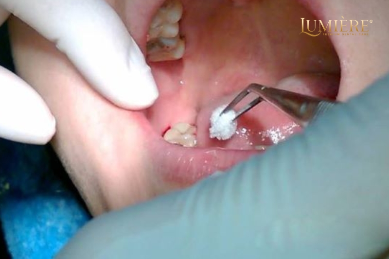 Dấu hiệu nhiễm trùng sau khi nhổ răng khôn và cách phòng ngừa 4 Cách phòng ngừa nhiễm trùng sau khi nhổ răng khôn