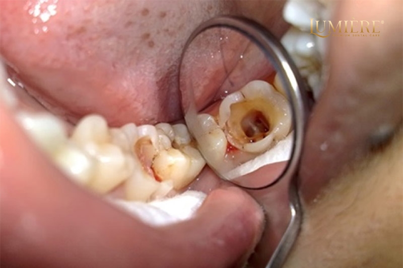 Giá nhổ răng số 8? Những yếu tố ảnh hưởng đến chi phí 2 Chi phí nhổ răng số 8 bao gồm những gì?