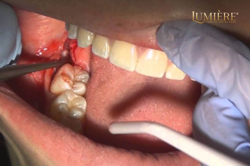 Giá nhổ răng số 8? Những yếu tố ảnh hưởng đến chi phí 3 Các yếu tố ảnh hưởng đến chi phí nhổ răng số 8