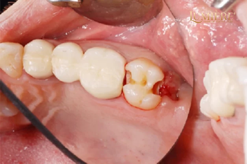 Giá nhổ răng số 8? Những yếu tố ảnh hưởng đến chi phí 1 Chi phí nhổ răng số 8 bao gồm những gì?