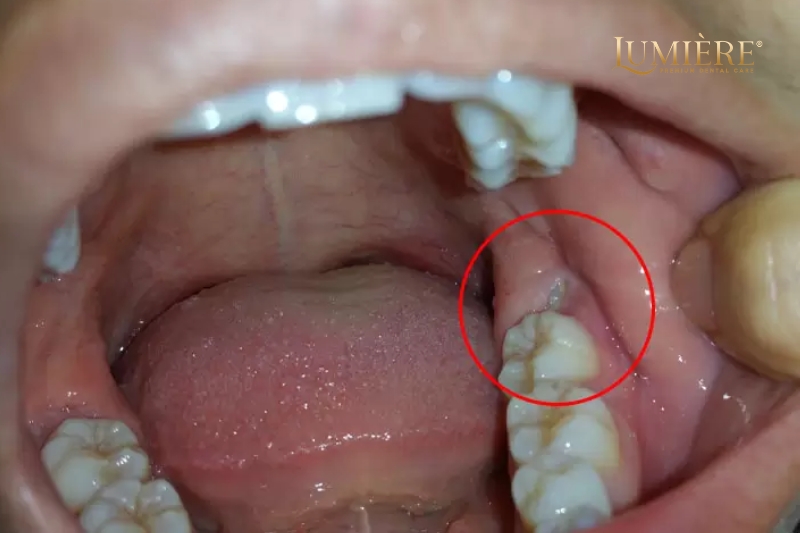 Không nhổ răng khôn có sao không? Nguyên nhân và cách phòng ngừa 2 Rủi ro của việc không nhổ răng khôn