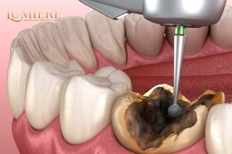 Nhổ răng hàm trên và dưới: quy trình an toàn và hiệu quả 3 Quy trình nhổ răng hàm