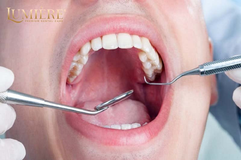 Nhổ răng hàm trên và dưới: quy trình an toàn và hiệu quả 2 Nhổ răng hàm trên và dưới có gì khác nhau?