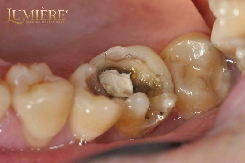 Nhổ răng hàm trên và dưới: quy trình an toàn và hiệu quả 4 Hiệu quả mang lại sau khi nhổ răng hàm