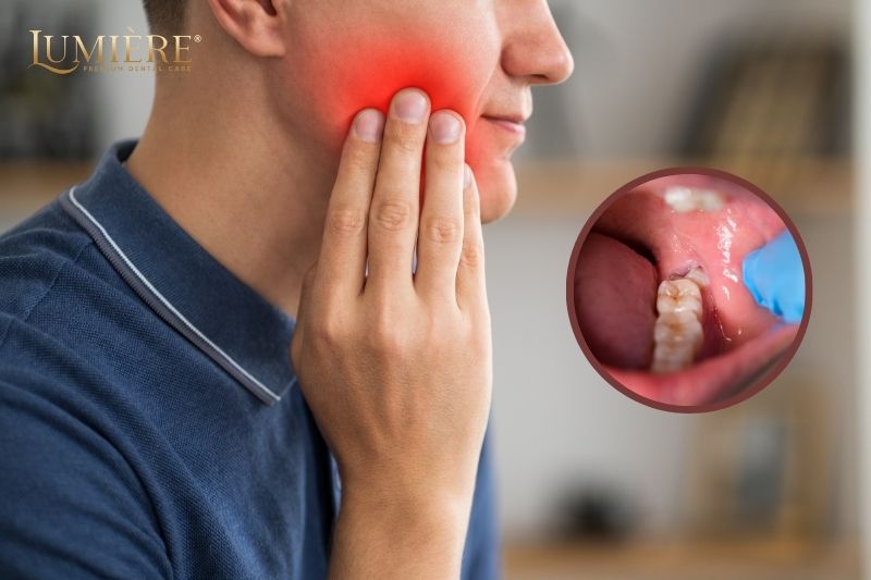 Nhổ Răng Khôn Có Đau Không? Bí Quyết Giảm Đau Sau Khi Nhổ Răng Khôn 2 Thông thường, nhổ răng khôn đau mấy ngày?
