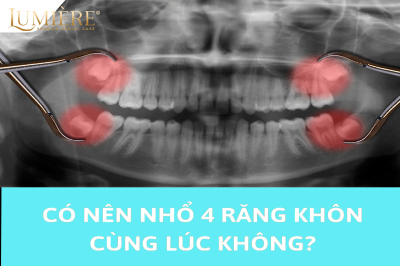 Có nên nhổ 4 răng khôn cùng lúc? Lợi ích và rủi ro gặp phải 3 Có nên nhổ răng khôn cùng lúc không/