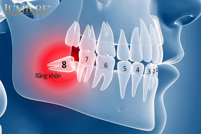 Có nên nhổ 4 răng khôn cùng lúc? Lợi ích và rủi ro gặp phải 2 Rủi ro có thể gặp phải khi nhổ 4 răng cùng lúc
