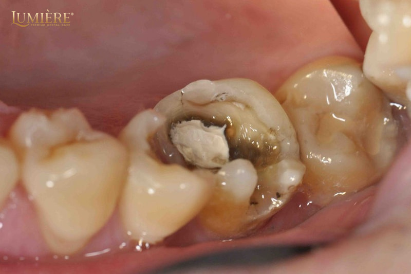 Nhổ răng có nguy hiểm không? Những lưu ý cần tránh 3 Những lưu ý cần tránh sau khi nhổ răng