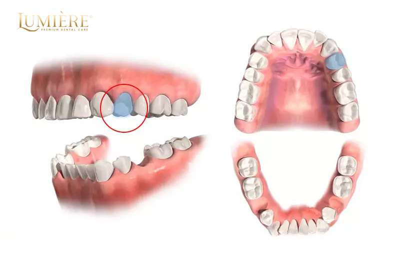 Tại sao trước khi niềng răng cần phải nhổ răng?