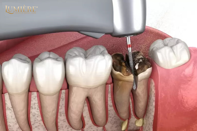 Nhổ răng số 7 nên trồng lại hay không? 5 lý do bạn nên trồng lại 2 Nhổ răng số 7 có nguy hiểm không?