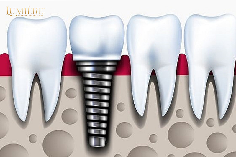 Nhổ răng số 7 nên trồng lại hay không? 5 lý do bạn nên trồng lại 1 Răng số 7 có vai trò gì?