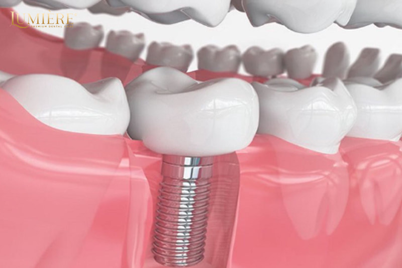 Nhổ răng số 7 nên trồng lại hay không? 5 lý do bạn nên trồng lại 3 5 Lý do bạn nên trồng lại răng số 7