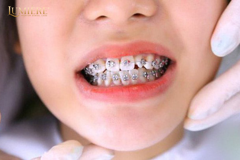 Quy trình niềng răng hô nhổ nhiều răng và giải pháp hiệu quả 3 Giải pháp hiệu quả cho răng hô nặng tại nha khoa Lumière Denta