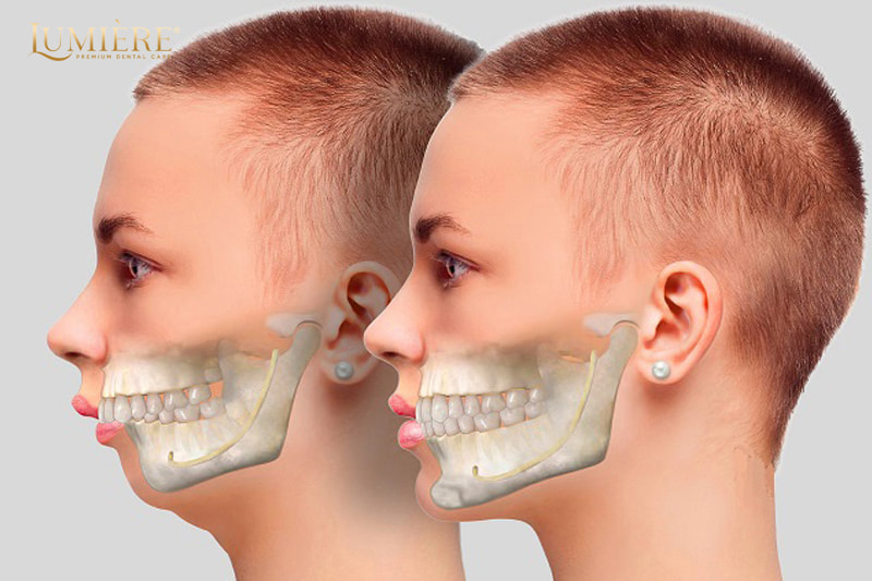 Quy trình niềng răng hô nhổ nhiều răng và giải pháp hiệu quả 1 Tại sao phải cần nhổ răng khi niềng hô?