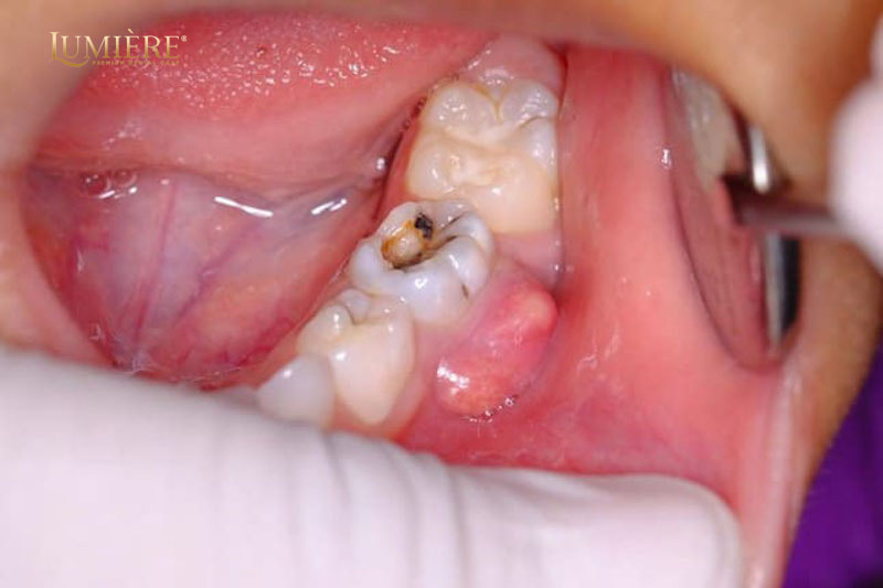 Răng số 7 bị sâu có nên nhổ không? Dấu hiệu và cách xử lý 2 Cách xử lý khi răng số 7 bị sâu và chi phí điều trị