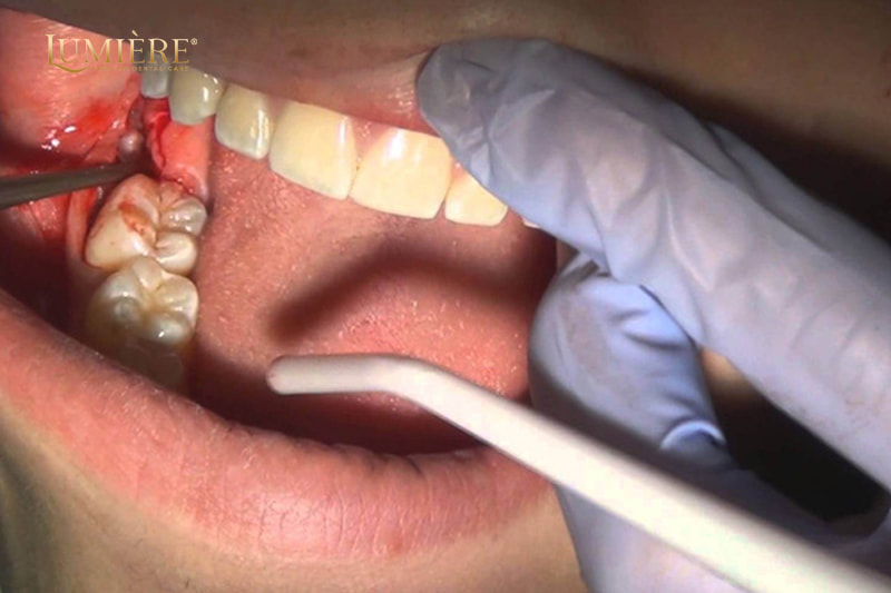 Răng số 7 bị sâu có nên nhổ không? Dấu hiệu và cách xử lý 1 Dấu hiệu nhận biết răng số 7 bị sâu