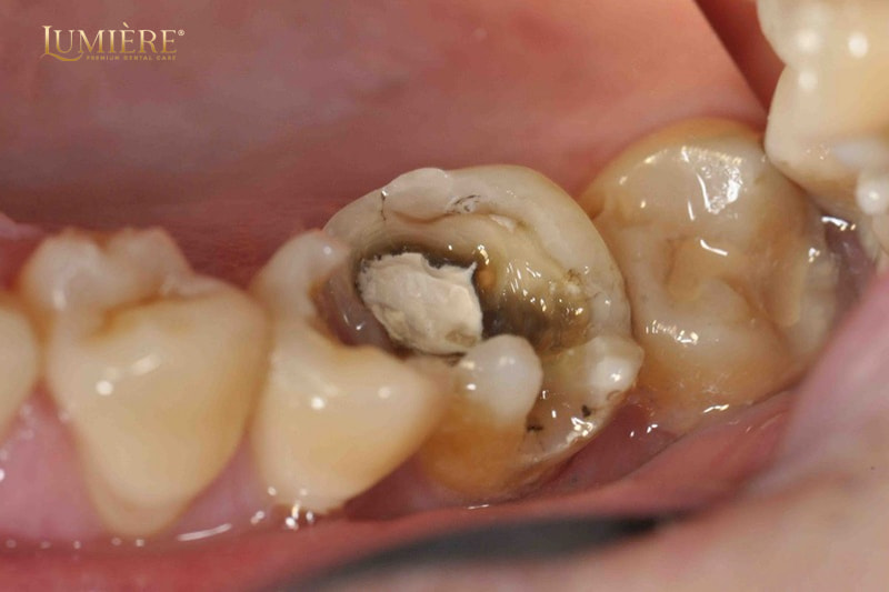 Tác hại của việc không nhổ răng sâu: Nhiễm trùng, thậm chí mất mạng 2 Răng sâu có tự lành lại được không?