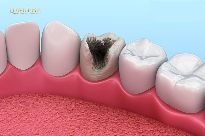 Tác hại của việc không nhổ răng sâu: Nhiễm trùng, thậm chí mất mạng 1 Nguyên nhân dẫn đến tình trạng răng sâu
