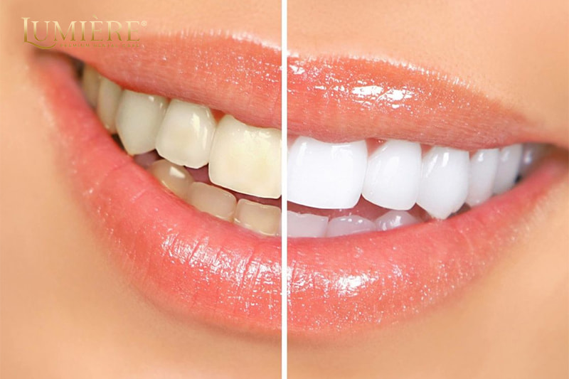 Cách tẩy trắng răng tại nhà hiệu quả, an toàn bạn nên biết 2 Nguyên nhân khiến răng bị ố vàng, xỉn màu