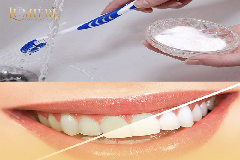 Cách tẩy trắng răng tại nhà hiệu quả, an toàn bạn nên biết 1 Tẩy trắng răng là gì?