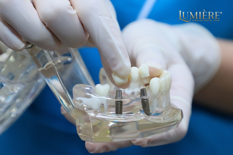 Cấy ghép Implant mất bao lâu? Những điều cần lưu ý 2 Những yếu tố ảnh hưởng đến thời gian cấy ghép implant