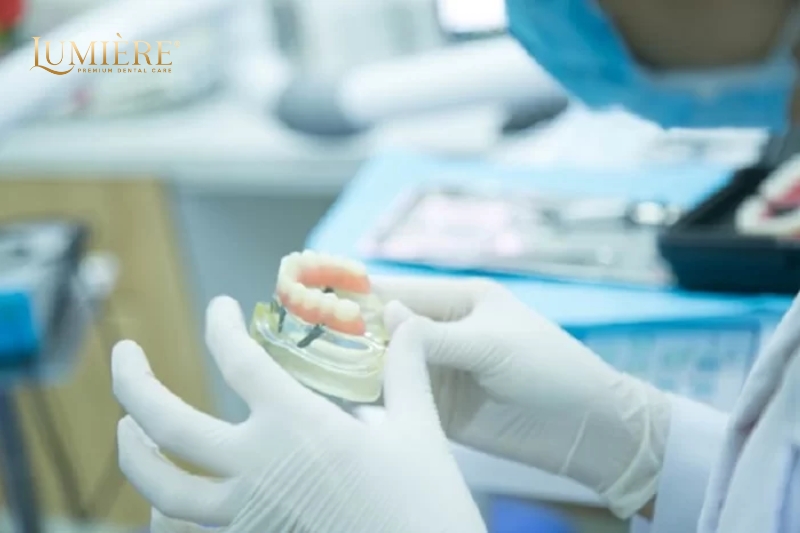 Cấy ghép Implant mất bao lâu? Những điều cần lưu ý 1 Cấy ghép implant mất bao lâu?