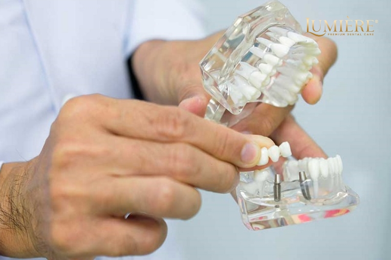Cấy ghép Implant mất bao lâu? Những điều cần lưu ý 3 Một số câu hỏi thường gặp về cấy ghép implant