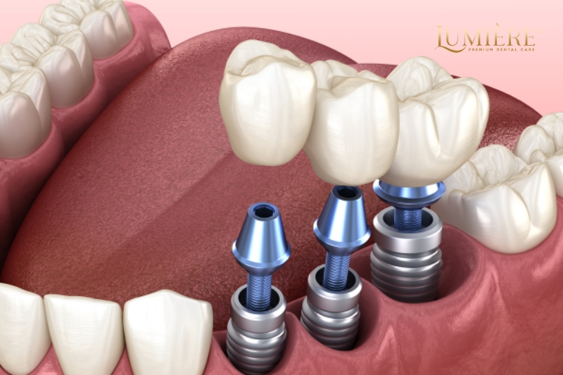 Kinh nghiệm trồng răng implant và cách chăm sóc sức khỏe răng miệng 3 Cách chăm sóc sức khỏe răng miệng hiệu quả