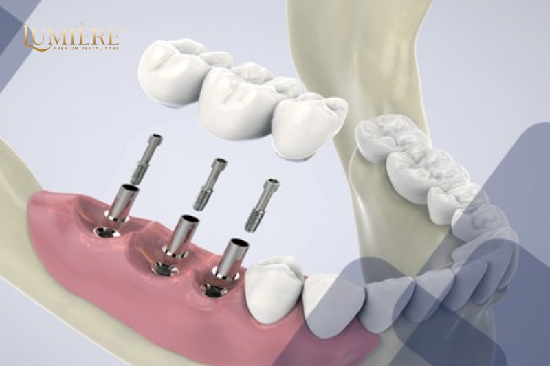 Kinh nghiệm trồng răng implant và cách chăm sóc sức khỏe răng miệng 2 Kinh nghiệm trồng răng implant hiệu quả