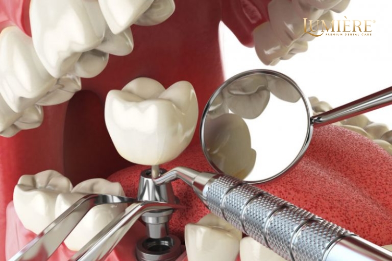 Kinh nghiệm trồng răng implant và cách chăm sóc sức khỏe răng miệng 1 Thời điểm trồng răng implant