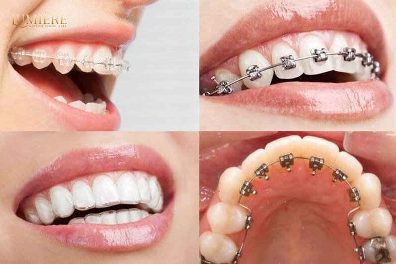 Kinh nghiệm lựa chọn Nha khoa niềng răng uy tín tại TP.HCM 2 Chi phí niềng răng giá bao nhiêu?