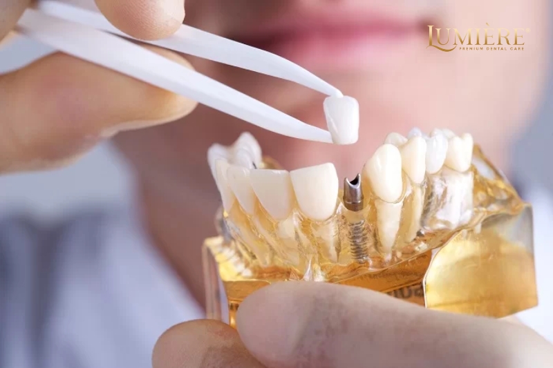 Trồng răng implant có nguy hiểm không? Những điều bạn cần biết 3 Những điều cần lưu ý khi trồng răng implant cho người già