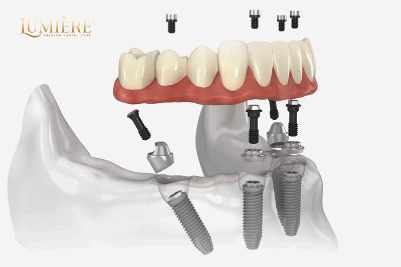 Trồng răng implant có nguy hiểm không? Những điều bạn cần biết 1 Trồng răng implant có nguy hiểm không?