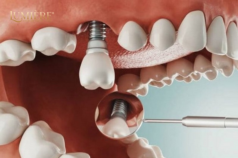 Trồng răng implant có nguy hiểm không? Những điều bạn cần biết 2 Lợi ích của trồng răng implant cho người già