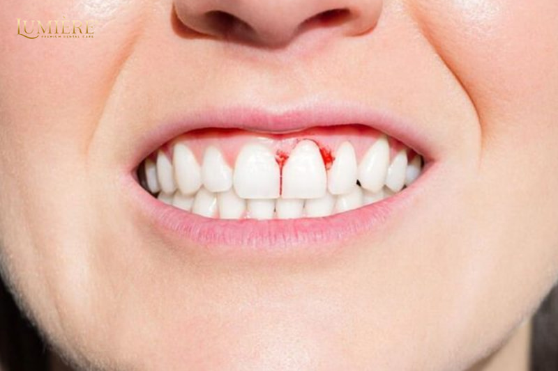 Chữa sưng nướu răng tại nhà: 5 phương pháp hiệu quả và an toàn 2 Dùng baking soda để chữa sưng nướu