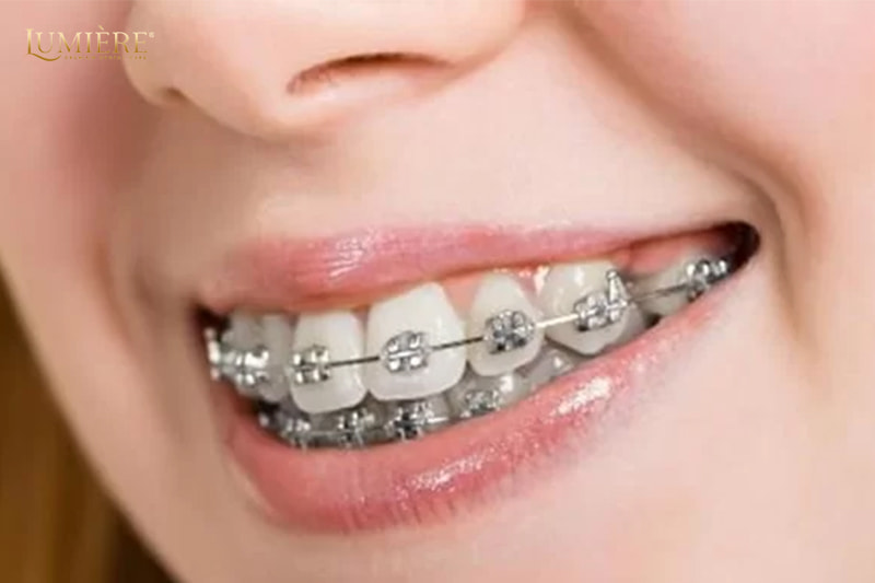 Giải đáp thắc mắc về niềng răng: Bí quyết sở hữu nụ cười hoàn hảo 2 Niềng răng bao lâu siết một lần?