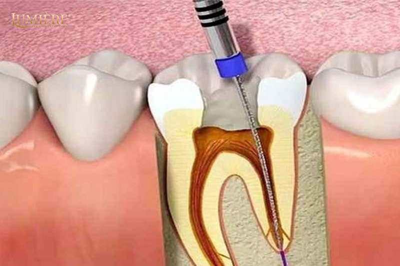 Lumière Denta - Giải đáp thức mắc về viêm tủy răng 3 Các phương pháp điều trị viêm tủy răng